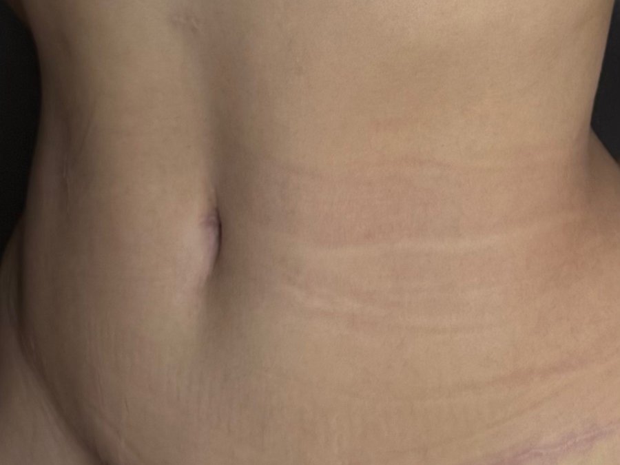 Abdominoplastia: depois da cirurgia